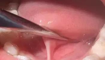 孩子割舌系带后说话不清楚怎么办,孩子说话不清楚要剪舌系带吗