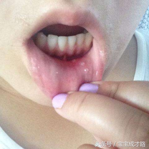 小孩咳嗽能用干柚子皮治疗吗,便秘吃西瓜皮有用吗