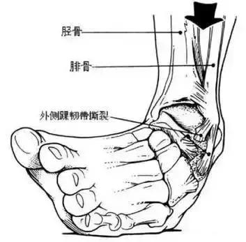 打球容易崴脚应当怎么锻炼,打球经常崴脚怎么锻炼
