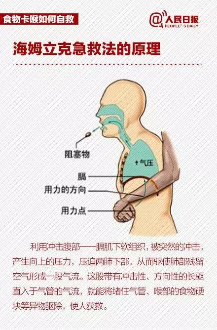 骨头卡喉咙用什么醋比较好,被骨头卡到喉咙喝醋有用吗
