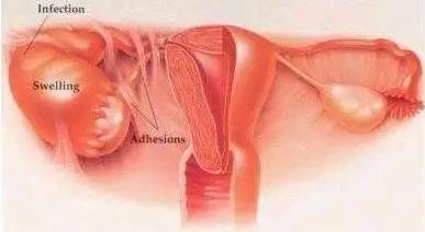 就医搜｜盆腔积液：女性都可能有的问题，需要治疗吗？