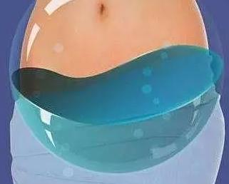 就医搜｜盆腔积液：女性都可能有的问题，需要治疗吗？