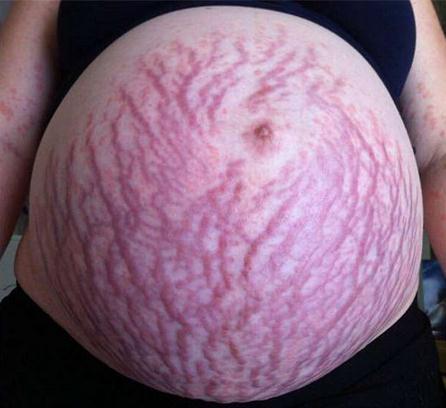 孕妇出现很多纹,孕妇肚子上长妊娠纹有拉扯感