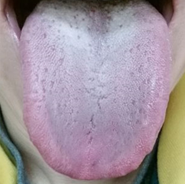 反流性胃炎中药饭前还是饭后服,为什么胃胀腹胀一直喝中药不见效