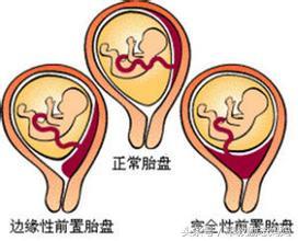 孕期胎盘有点低要注意什么,孕期胎盘低怎么避免弯腰