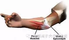 高尔夫球肘康复训练,高尔夫球肘康复训练后疼痛加重