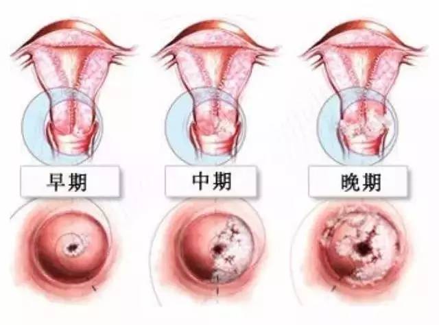 妇科癌症的症状10大前兆,一图看懂妇科炎症症状