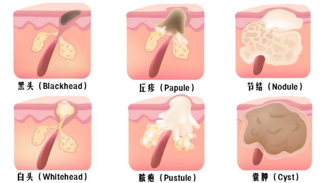 痘疮最好的治疗方法,疮痘是什么