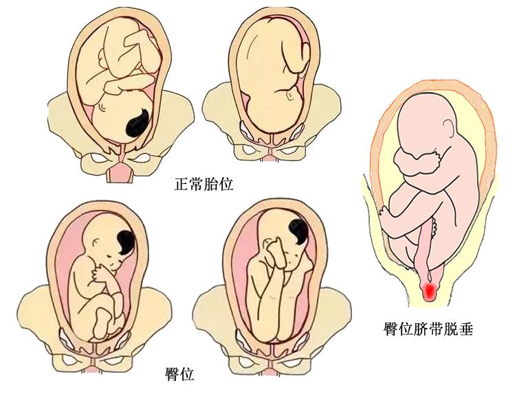 「产科医生日记」脐带脱垂，命悬一线！