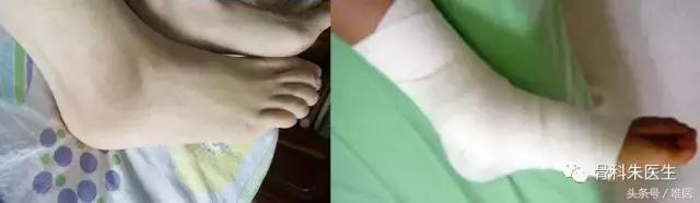 踝关节骨折和踝关节扭伤哪个严重,踝关节扭伤康复治疗注意事项