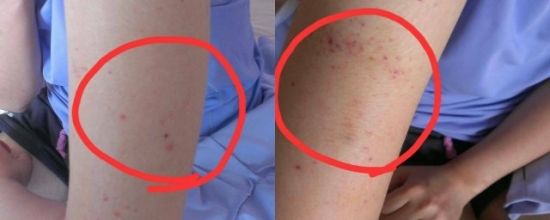 身上长小红点不痛不痒变成黑点,身上长红点像红色小痣怎么回事
