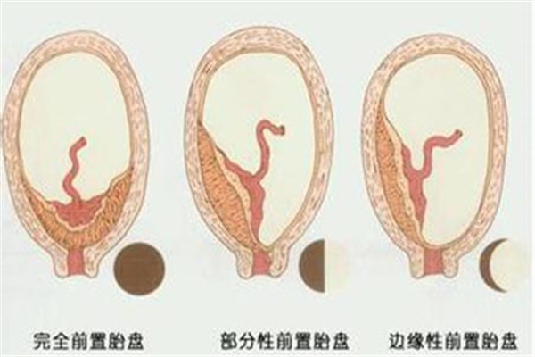 前壁胎盘是不是比较难感觉胎动,前壁胎盘如何变成完全性前置胎盘