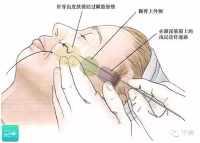 脸部缝美容线好还是普通线好,医院埋线和美容院埋线有什么差别