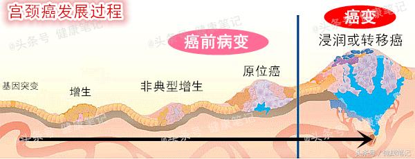 宫颈癌前病变CINIII，离宫颈癌有多远？能治愈吗？