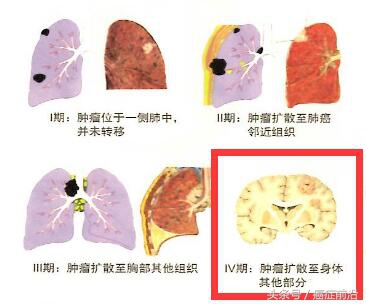 抗pd-1免疫治疗肺癌,肺癌早期靶基因治疗效果及费用