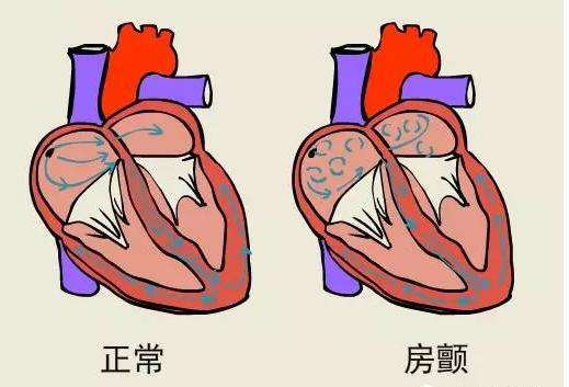 年轻人什么原因引起的房颤,年轻人房颤的原因