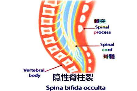 先天性脊柱裂可以治疗吗,脊柱裂怎么治疗
