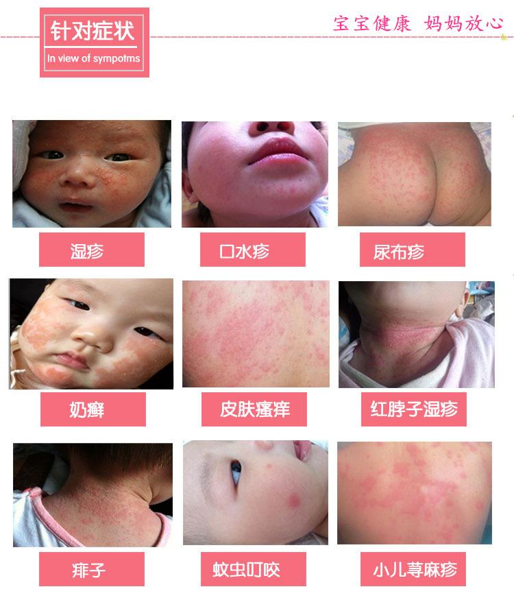 宝宝是长痱子还是湿疹该如何护理,小婴儿脸上脂溢性湿疹怎么护理