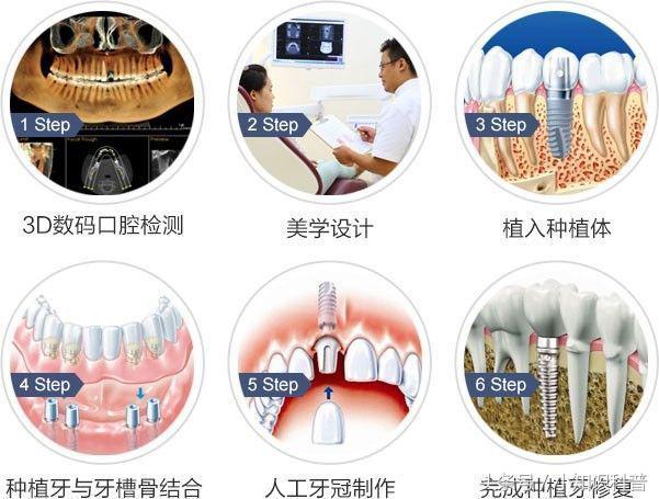 烤瓷牙中间缺牙可以做活动假牙吗,多颗牙缺失做烤瓷牙还是种植牙好