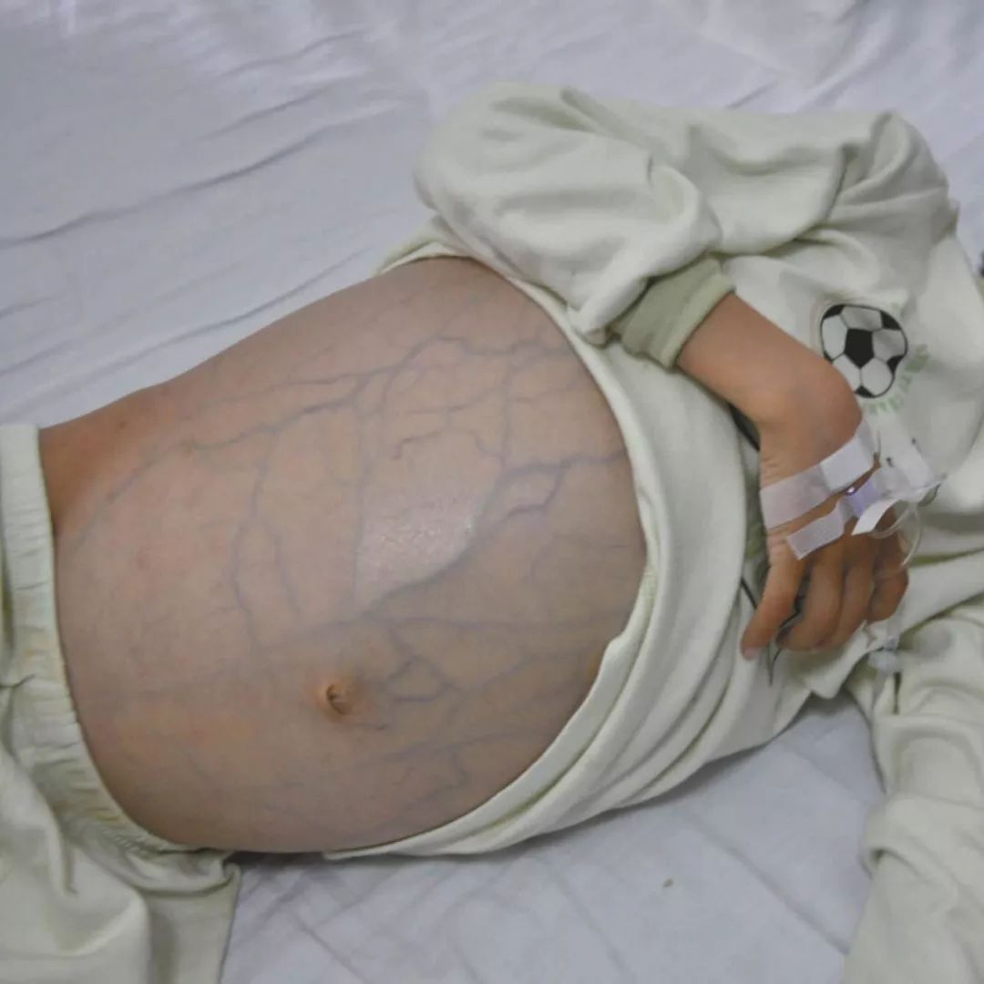 中医治疗恶性癌症腹水,腹膜后恶性癌症大量腹水能治好吗