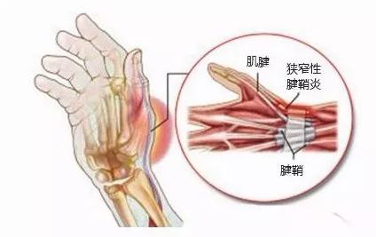 爱玩“跳一跳”要注意啦，手上这个部位很脆弱，当心跳出腱鞘炎！