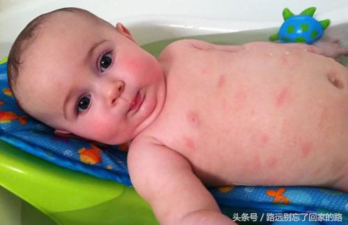 婴儿长湿疹可以吃合生元益生菌吗,益生菌可以调理湿疹吗