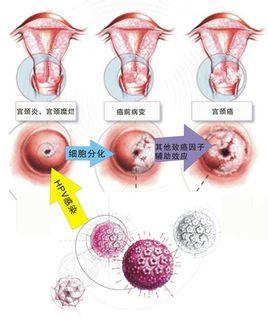 hpv常见问题和解决讲解,hpv常见问题及解决方法