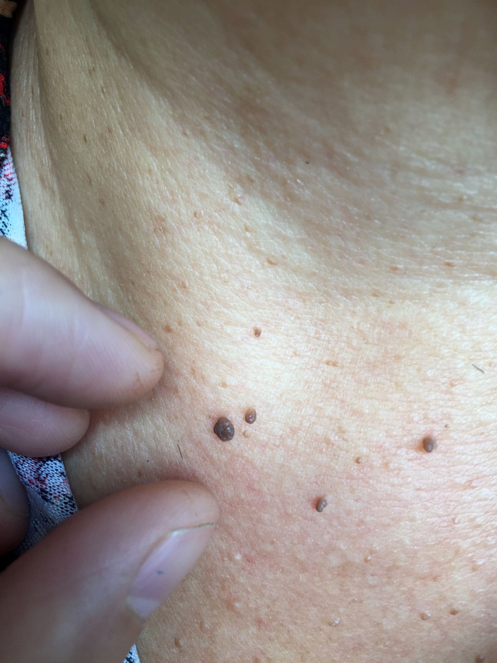 怀孕后脖子上和腋窝长了特别多的“小瘊子”，应当怎么办呢？
