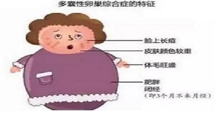 多囊卵巢综合症症状,多囊卵巢综合症有什么症状和表现