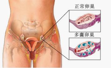 多囊卵巢综合症症状,多囊卵巢综合症有什么症状和表现
