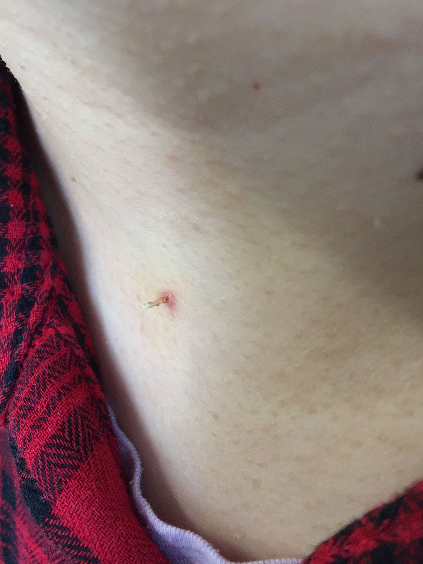 怀孕后脖子上和腋窝长了特别多的“小瘊子”，应当怎么办呢？