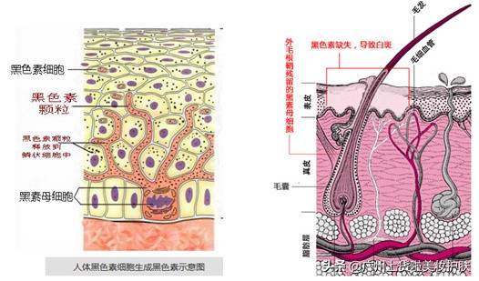 对付褐黑色痘印,对付黑痘印最有效的成分