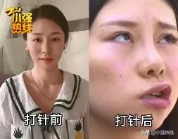 杭州姑娘打瘦脸针后竟然面瘫了,打瘦脸针面瘫后续