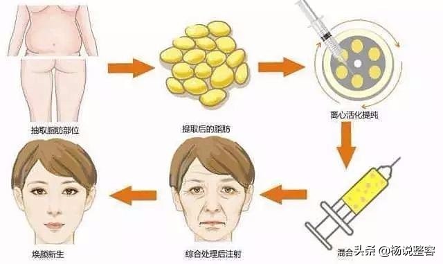 科普：自体脂肪面部填充有哪些优缺点、有哪些风险呢？