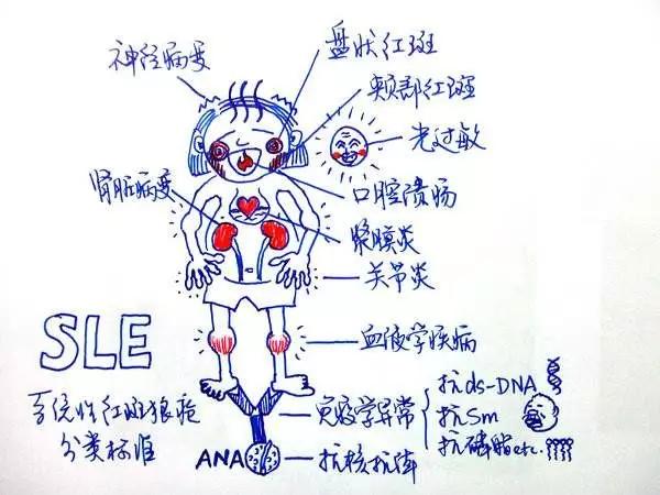 干细胞治疗红斑狼疮最新消息,干细胞治疗红斑狼疮临床研究