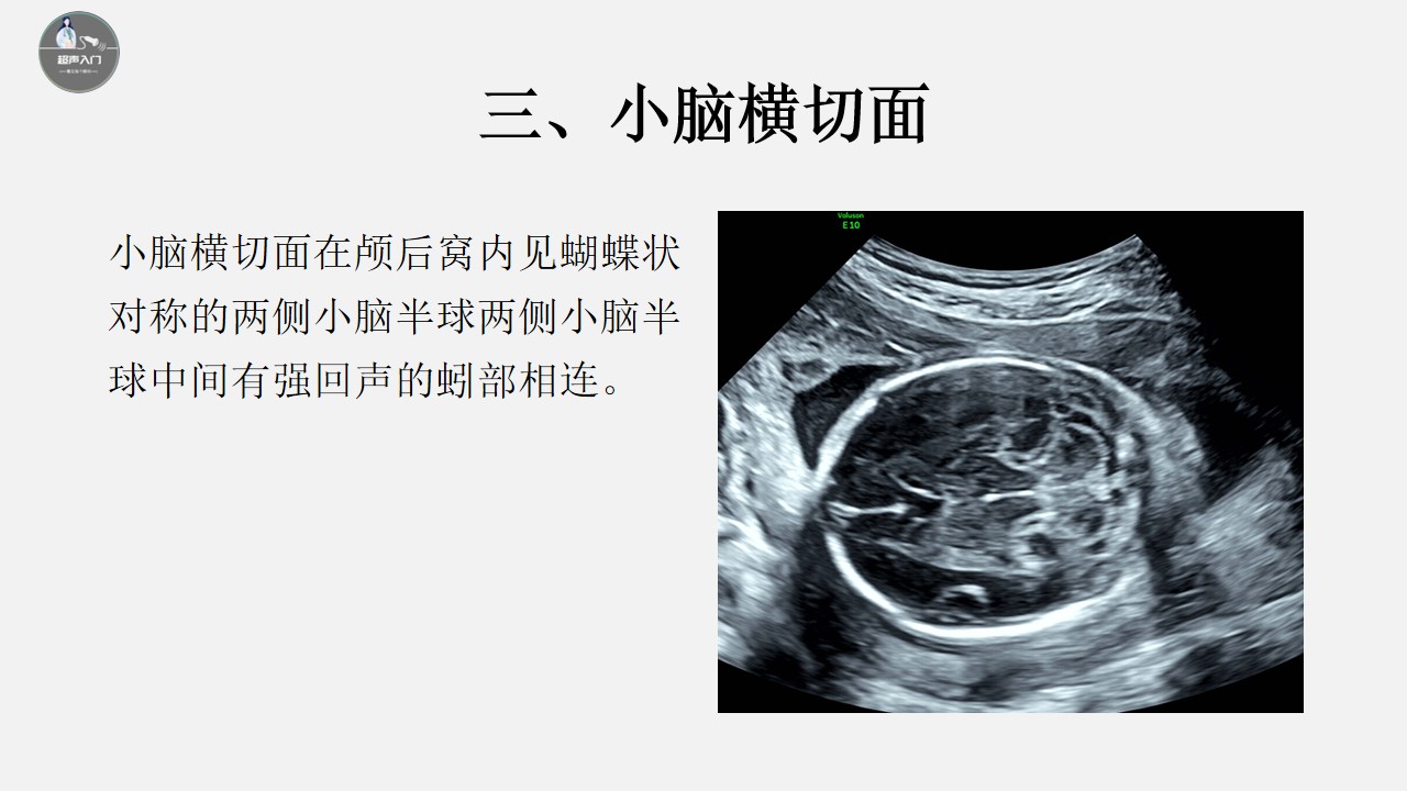 胎儿颅脑超声标准切面图解,胎儿颅脑异常的超声诊断ppt