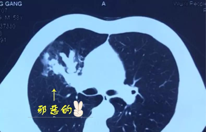 肺癌晚期皮肤过敏怎么回事,肺癌晚期是否会引起过敏