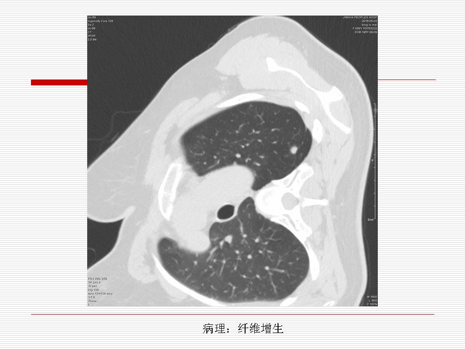 像炎症的肺癌能治好吗,医生说可能是肺癌也可能是炎症
