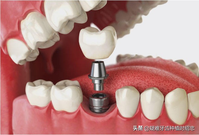 牙根拔出来好还是不拔好,拔牙根之前需要注意什么