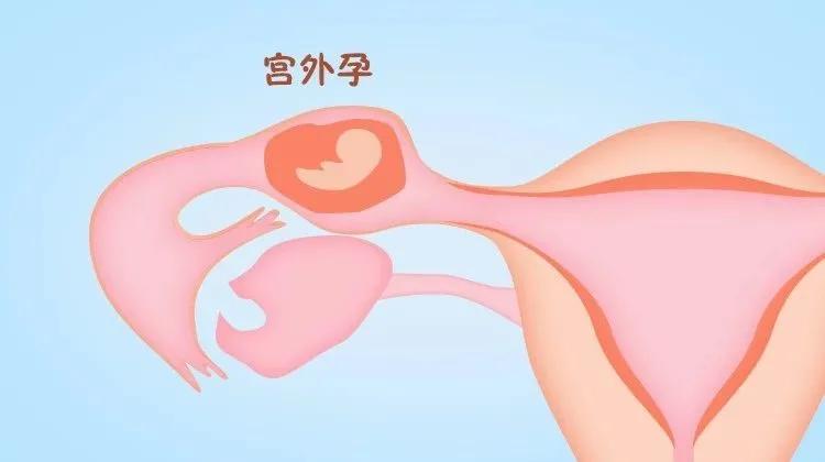 宫外孕微创手术多久可以试管婴儿,宫外孕后多久可以做试管