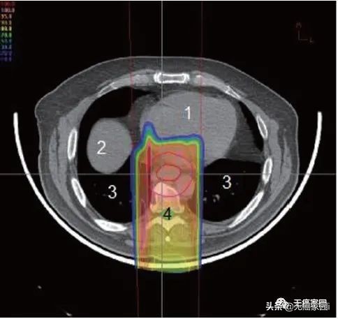 质子治疗消化道癌症,质子重离子治疗肠胃瘤