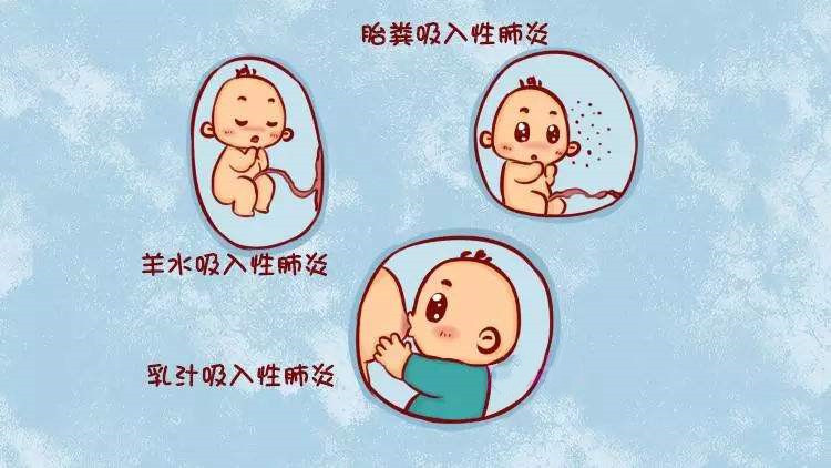 新生儿肺炎是怎么引起的怎样治疗,新生儿肺炎严重的症状有哪些