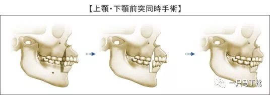 凸下巴凹面型脸怎么改变,脸宽但下巴尖怎么瘦下来