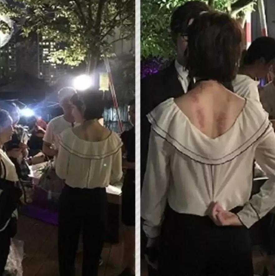完全没想到！明星也如此痴迷刮痧和拔火罐…