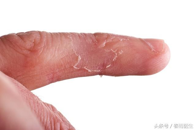 痒到抓破皮,有一种痒一抓就起水泡