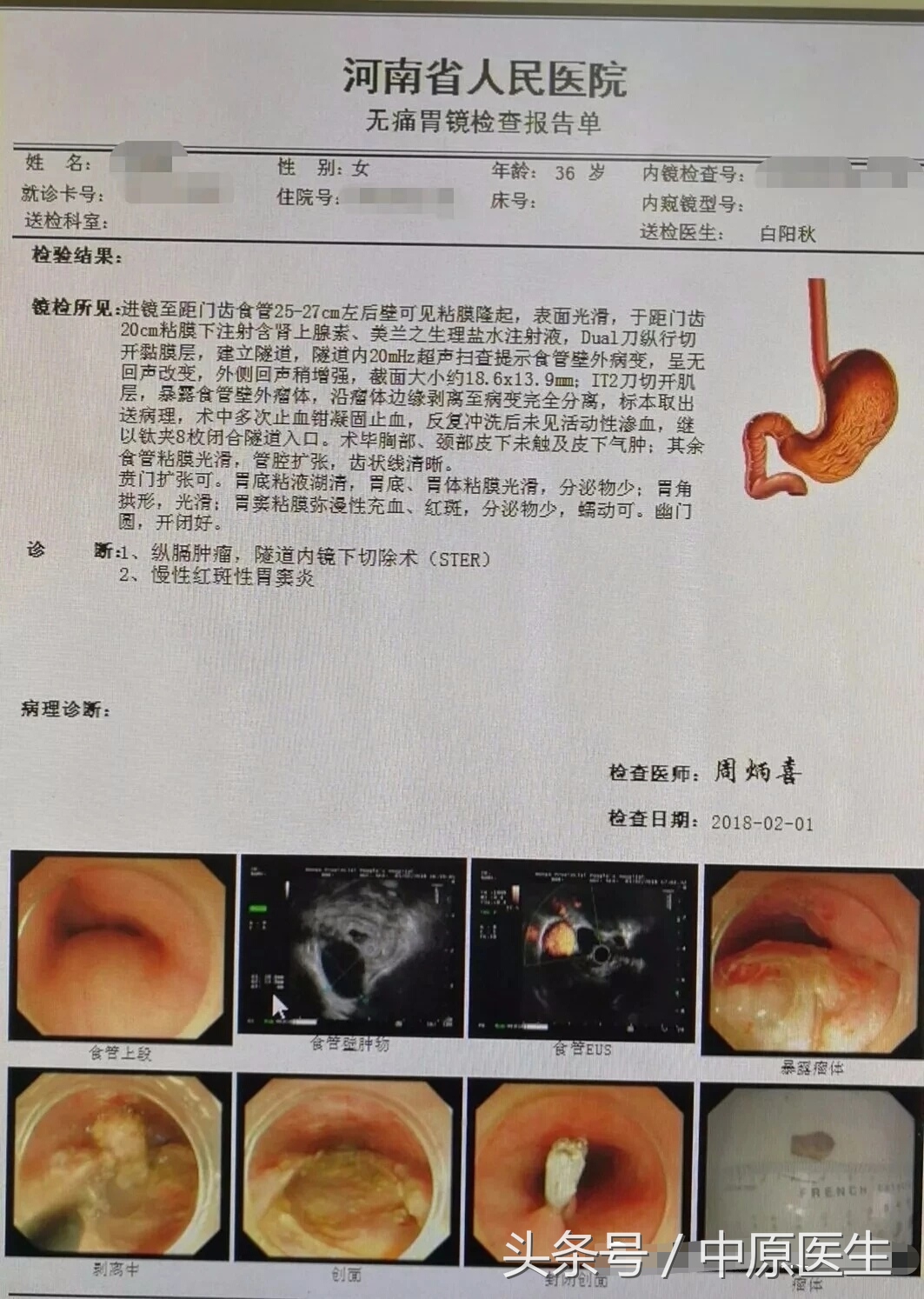 “挖窟窿”新进展：内科医生也耍手术刀，在食管开口切癌症
