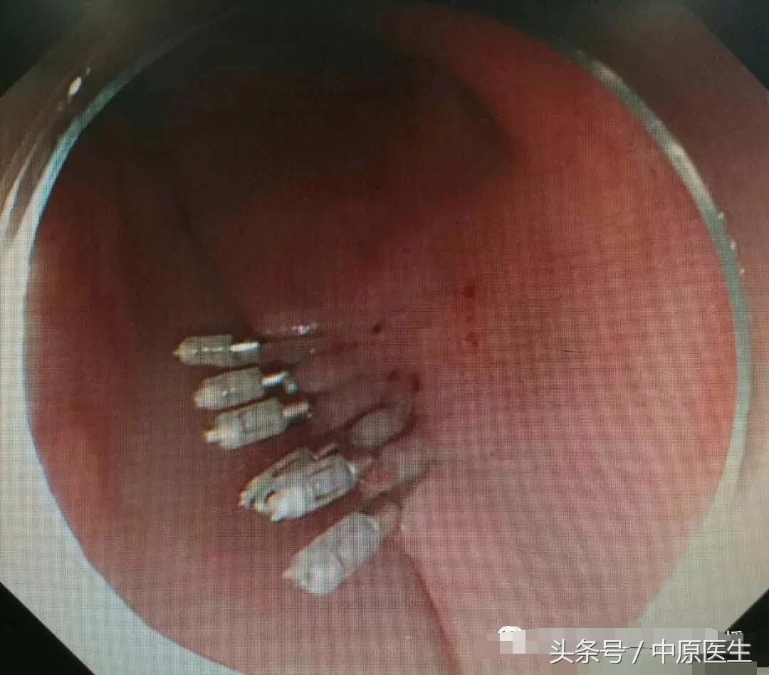“挖窟窿”新进展：内科医生也耍手术刀，在食管开口切癌症
