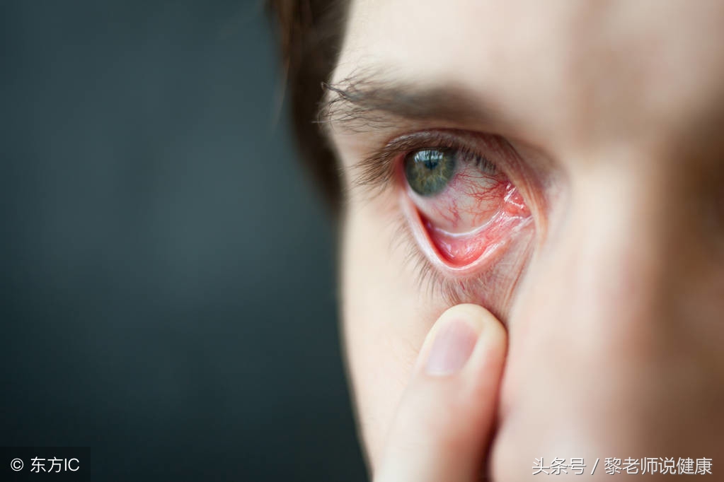 眼睛红痛而且流泪怎么治疗,眼睛疼眼角有红血丝怎么回事