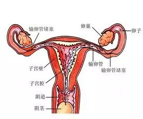 输卵管堵塞介入治疗法是怎么回事,输卵管堵塞介入治疗