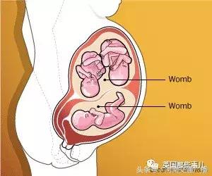 不完全双角子宫怀双胎,有人天生有两个子宫吗